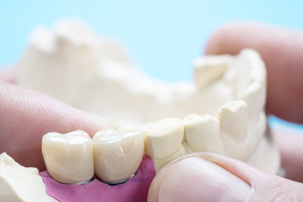 Dental Crowns & Bridges
